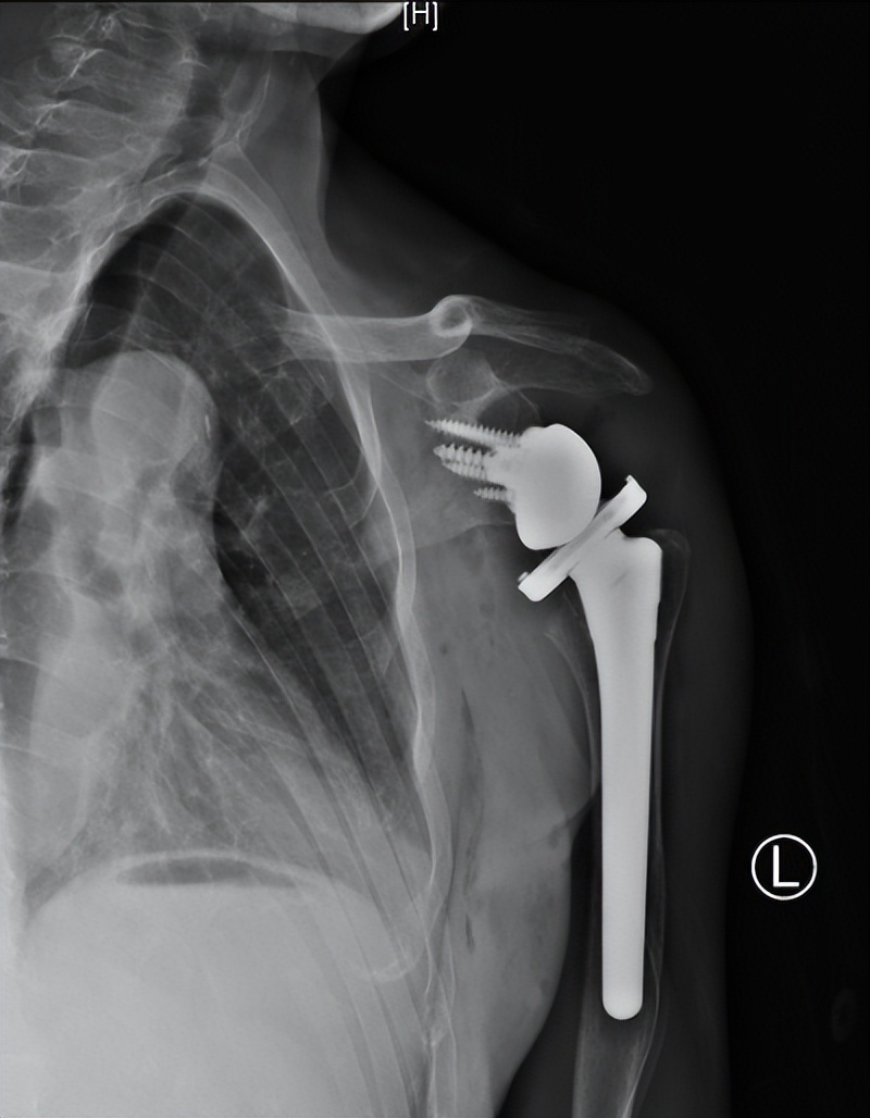 陈旧性肩关节脱臼有必要做手术吗,多年陈旧性肘关节脱臼