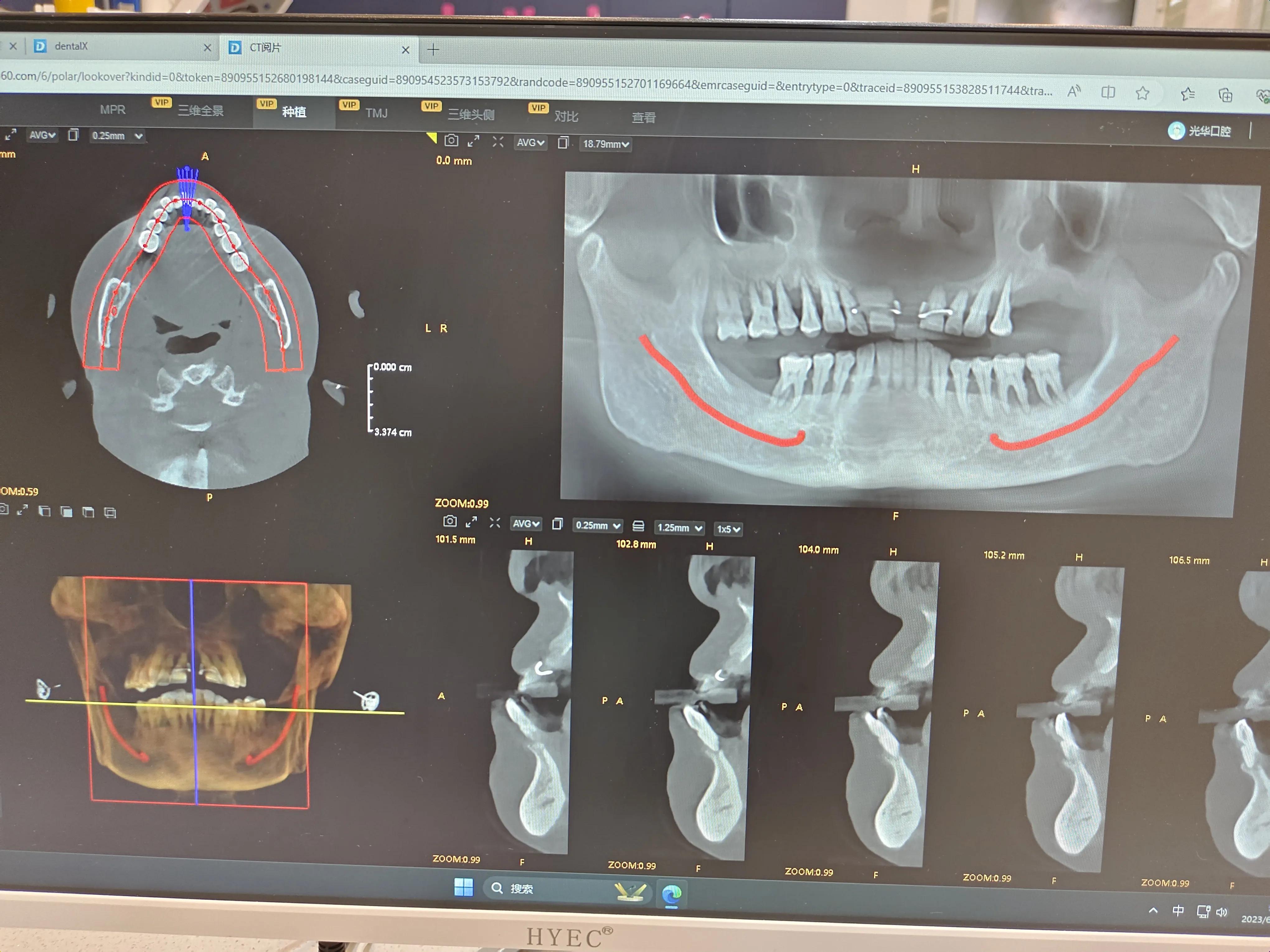 牙龈萎缩好几年了终于治好了,牙龈萎缩治好了案例