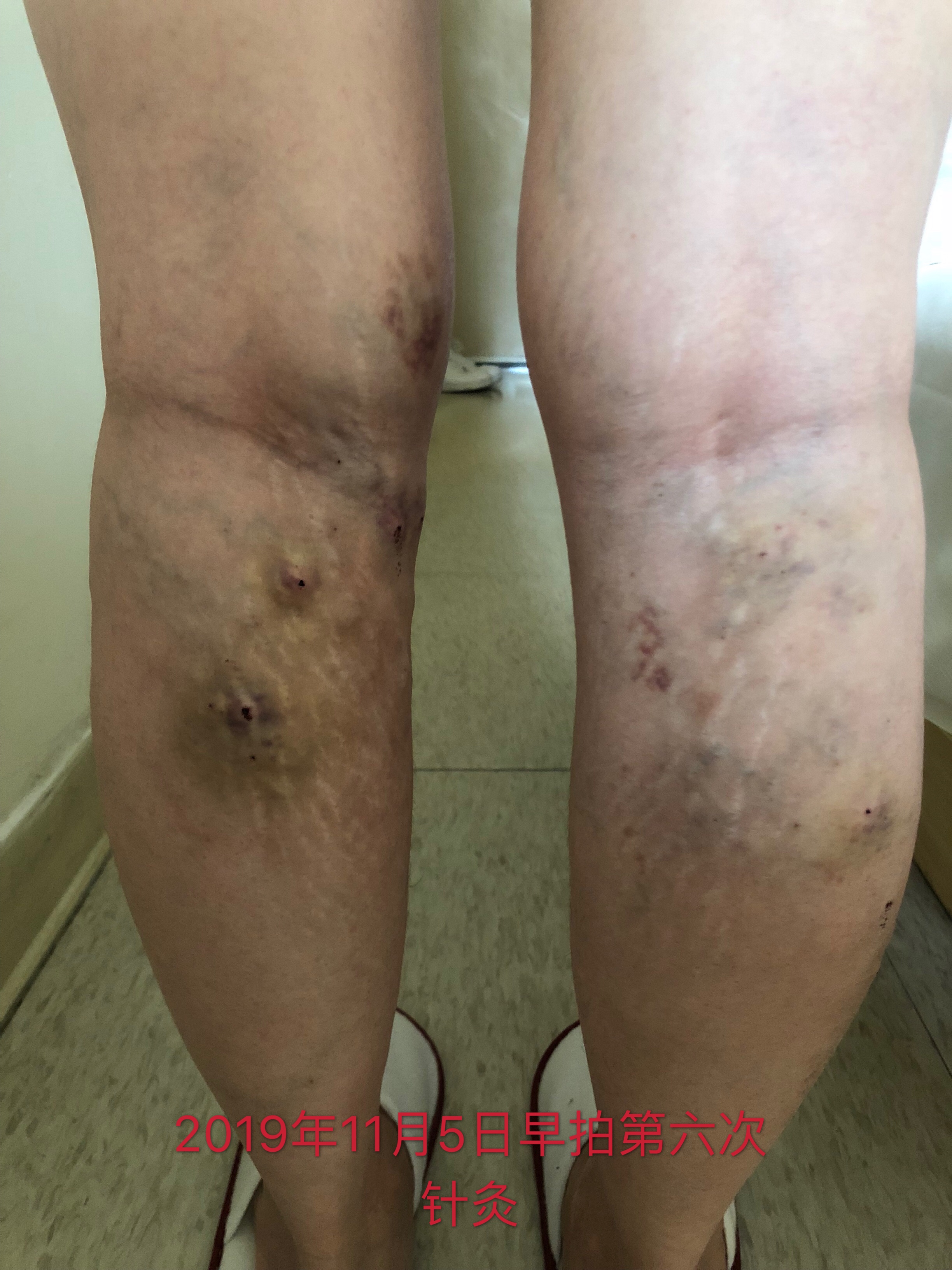 静脉曲张用银针刺是怎么治疗的,北京静脉曲张针刺疗法