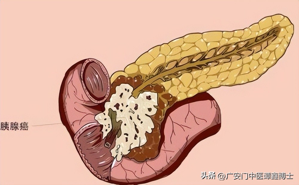 胰腺癌晚期饮食中药治愈成功案例,胰腺癌胆管支架后饮食注意事项