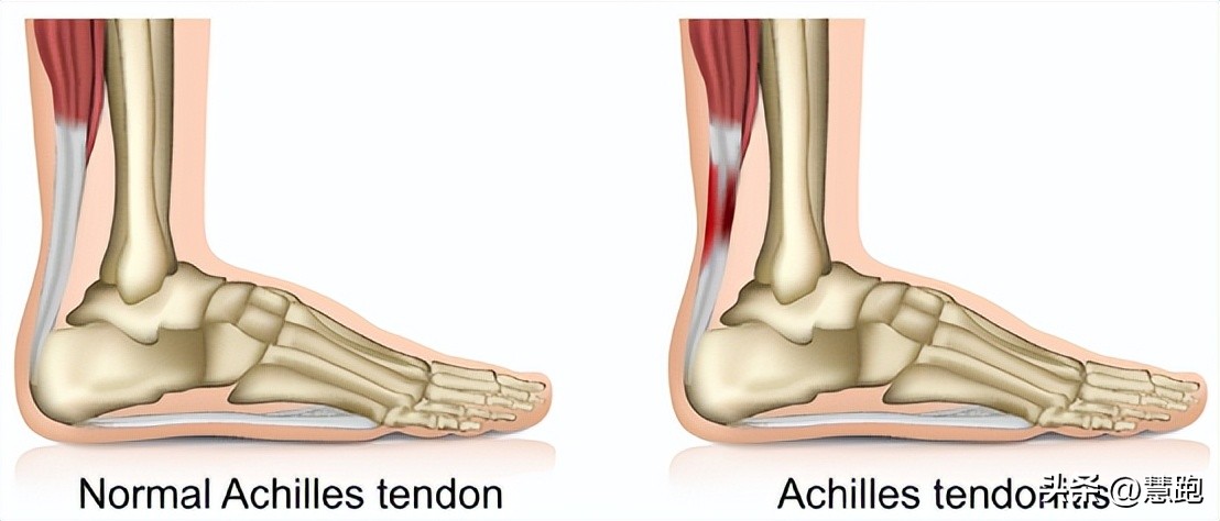 跑步减少受伤的5个方法,跑步六大伤痛解决方案