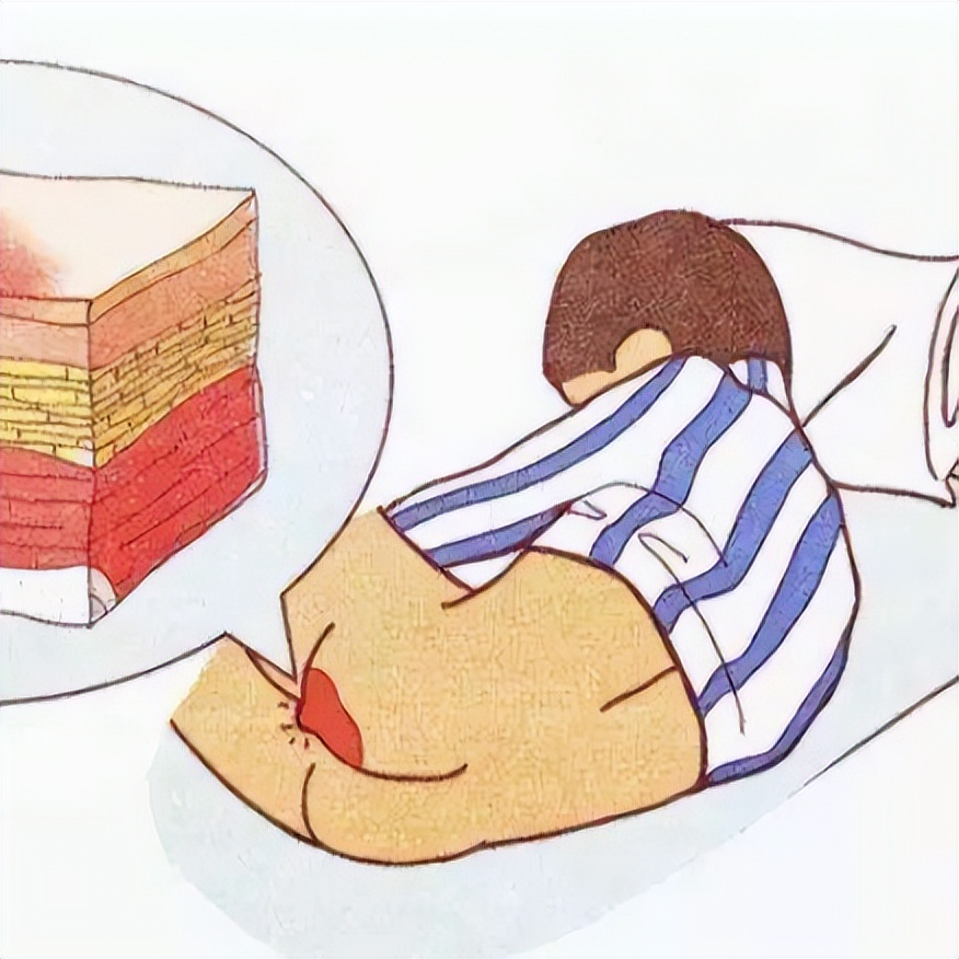 褥疮一期的症状和治疗方法,褥疮的最新分级及护理