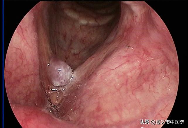 声音长期嘶哑是什么原因导致,劳累后声音就嘶哑是什么原因