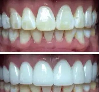 氟斑牙治疗的3种方法,氟斑牙怎么矫正