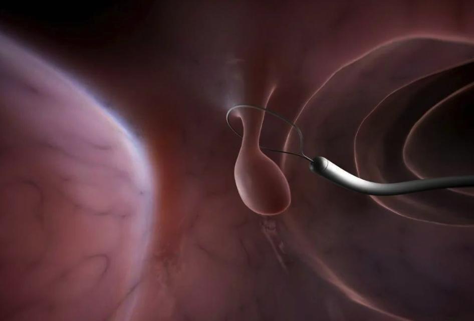 发现囊肿需要注意什么,医生说有囊肿但不要紧