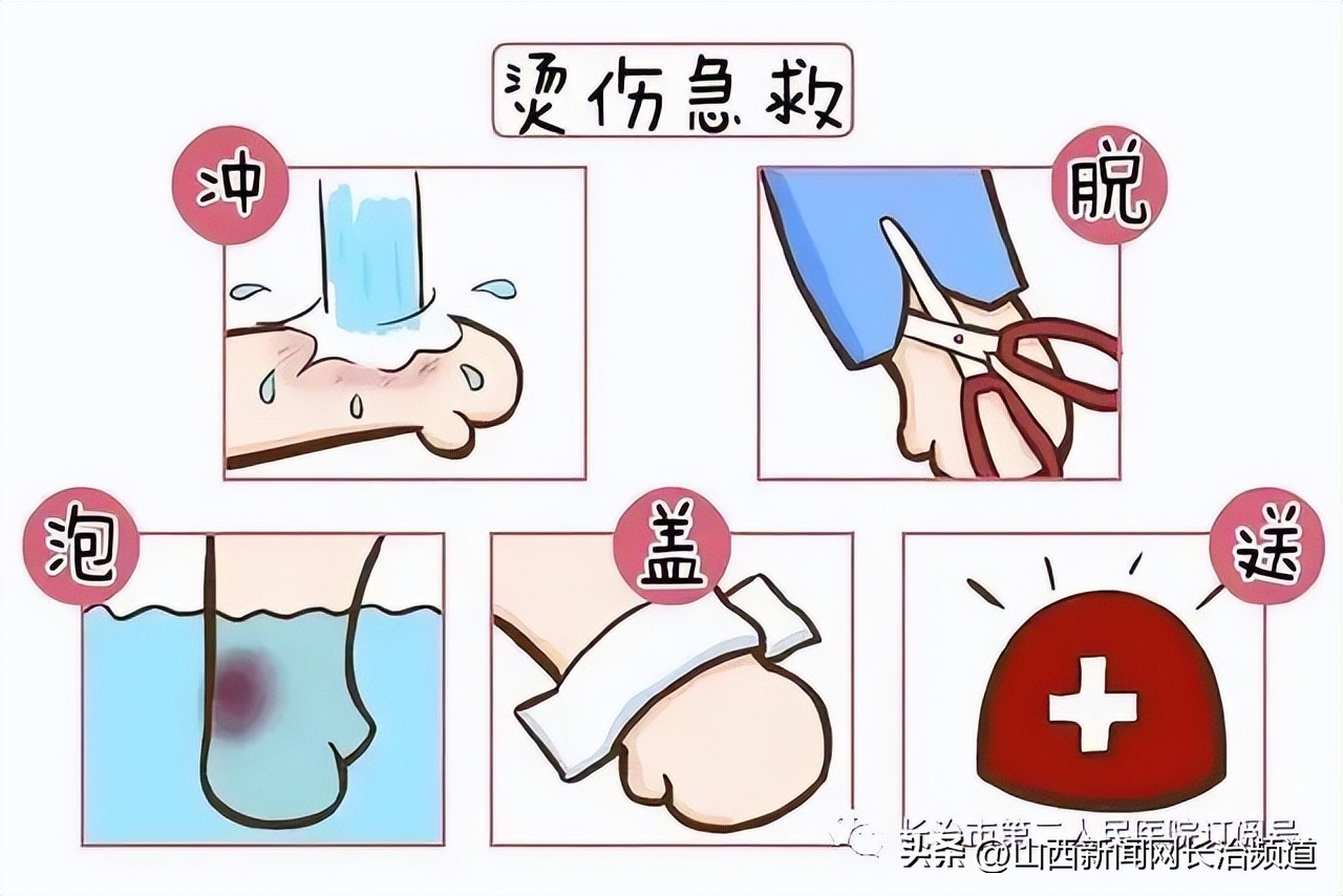 长治市第二人民医院：发生烧烫伤不要慌，正确急救处理办法来了