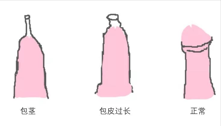 小男孩包皮长是病吗?要不要做手术割包皮,小儿外科医生这样说