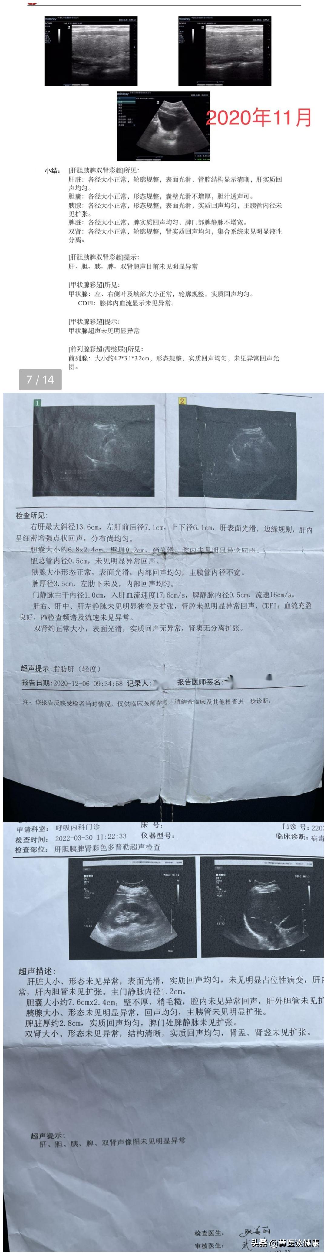 乙肝大三阳10多年,乙肝表面抗体升高至28说明什么