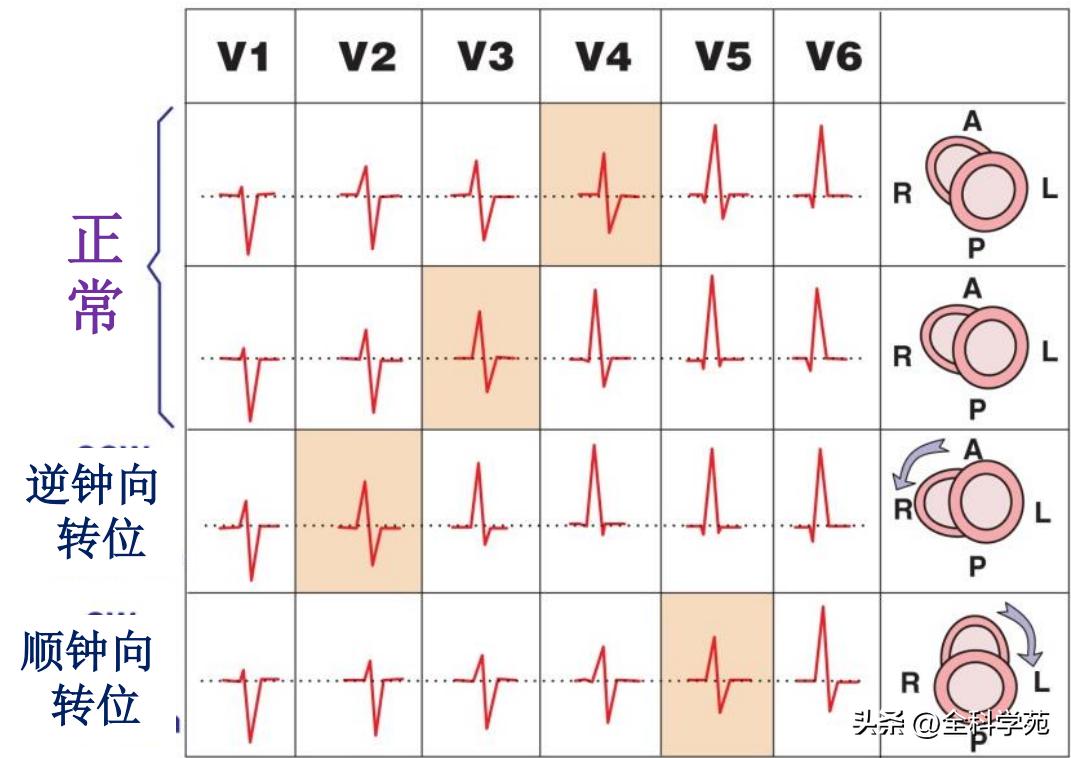 心电图笔记26：QRS波振幅变高，需要想到哪些