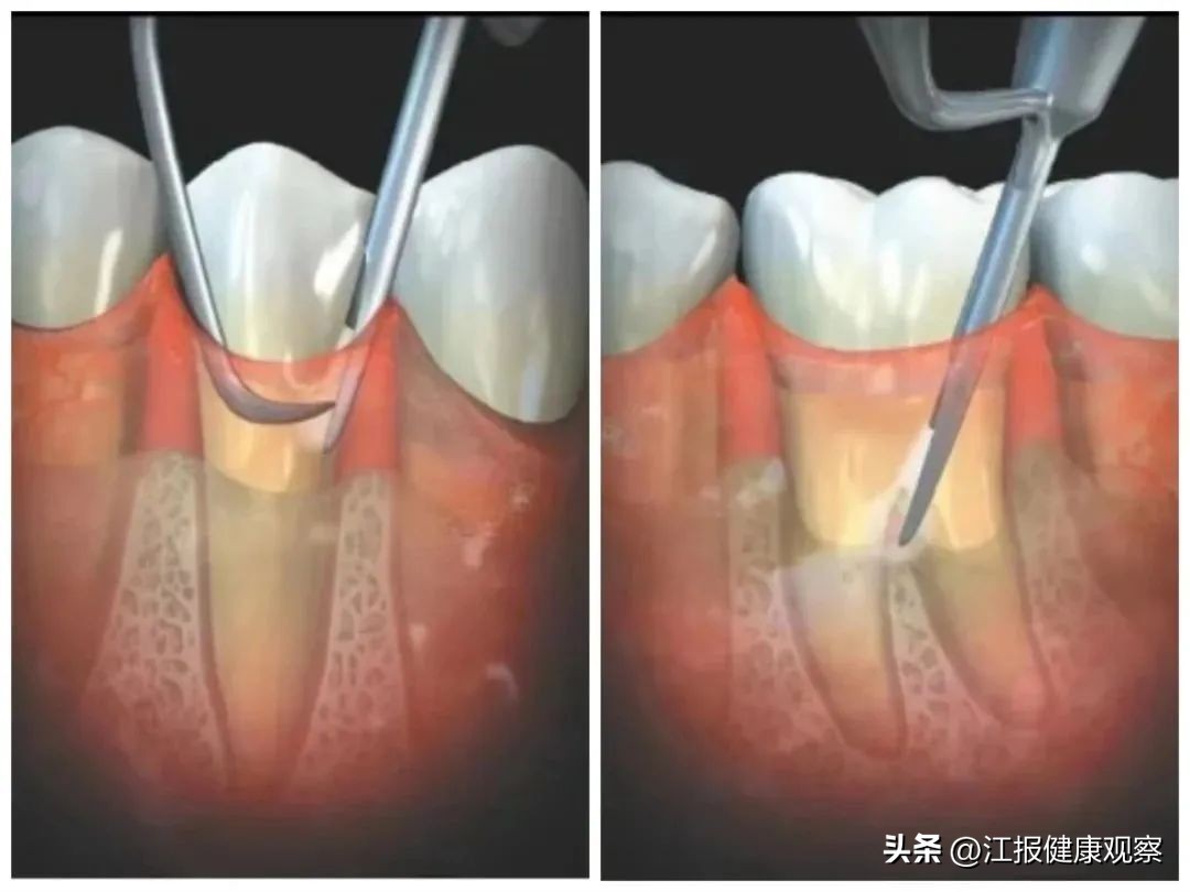 南昌大学附属口腔医院二次根管,南昌大学二附院牙科