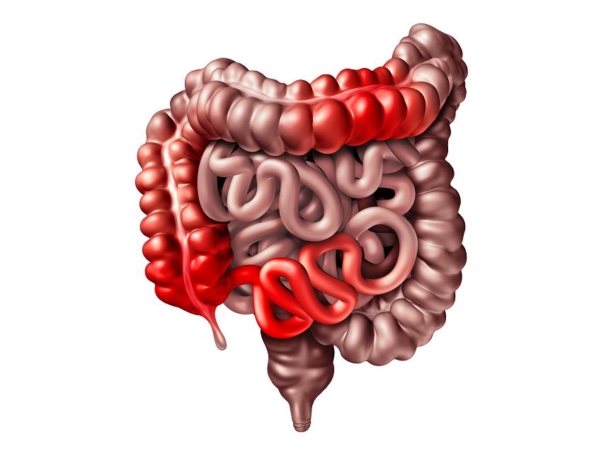 慢性肠炎，可由感染、过敏等因素引起？辅以这5款食疗药膳试一试
