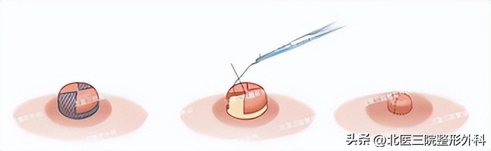 乳头乳晕畸形与缺损的整形修复