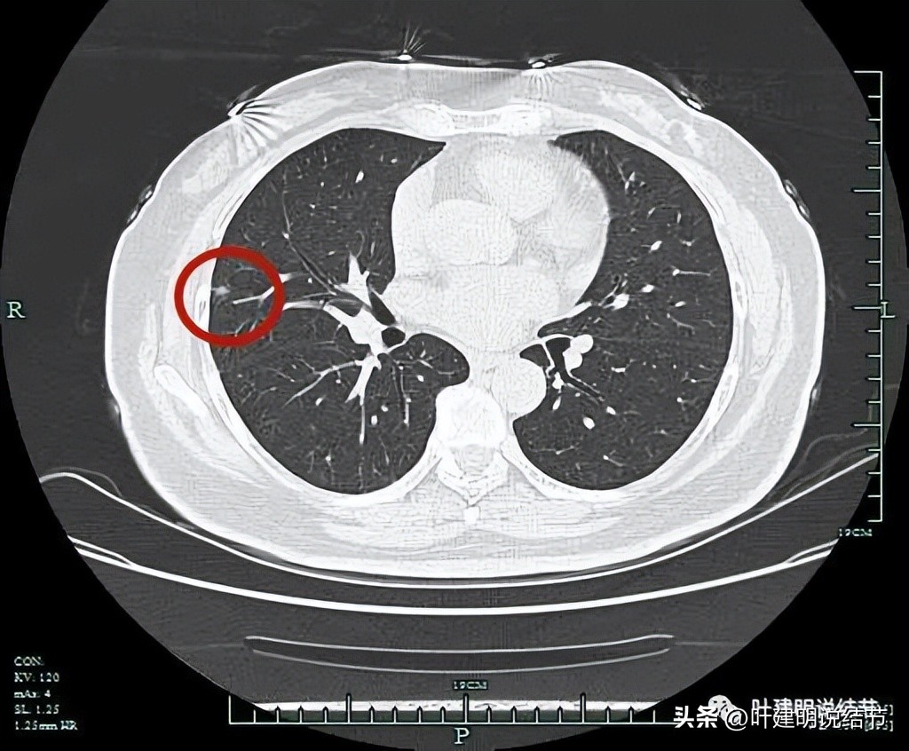 子宫内膜癌术后已经12年了,发现右肺结节,转移了?该不该手术?