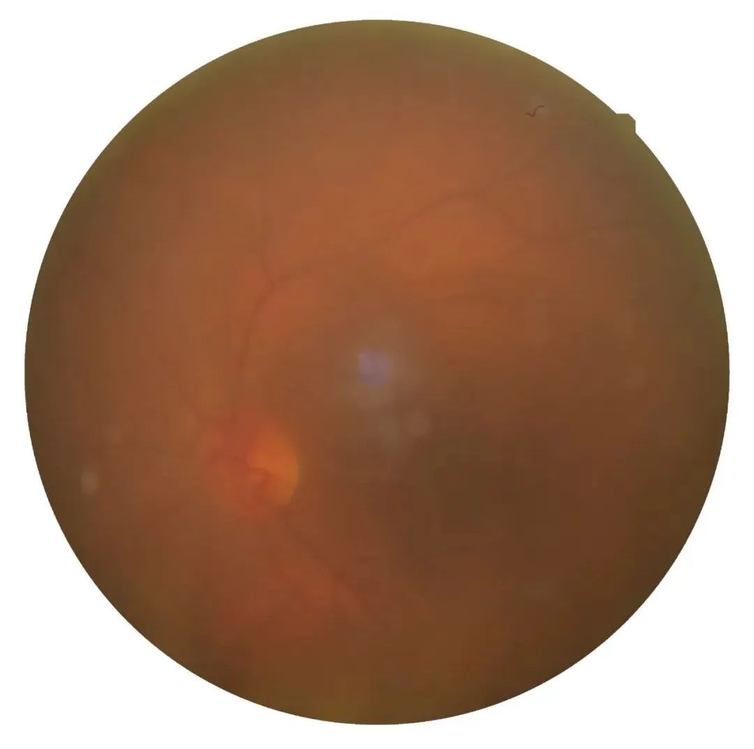 眼底出血术后忌什么中药,眼底出血中医有好办法吗