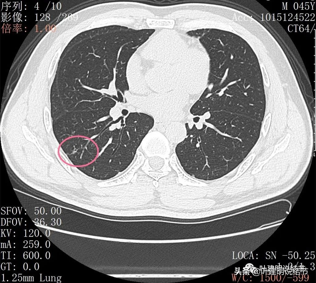 误诊肺纤维化,肺蜂窝状是癌吗