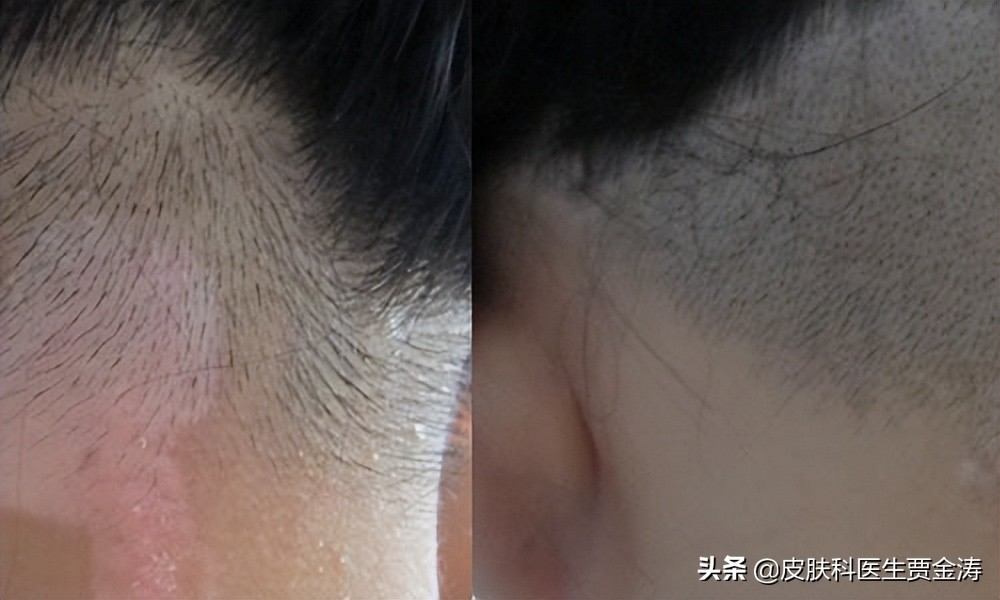 中医治疗白癜风成功案例有吗,白癜风中医还是西医治疗效果好