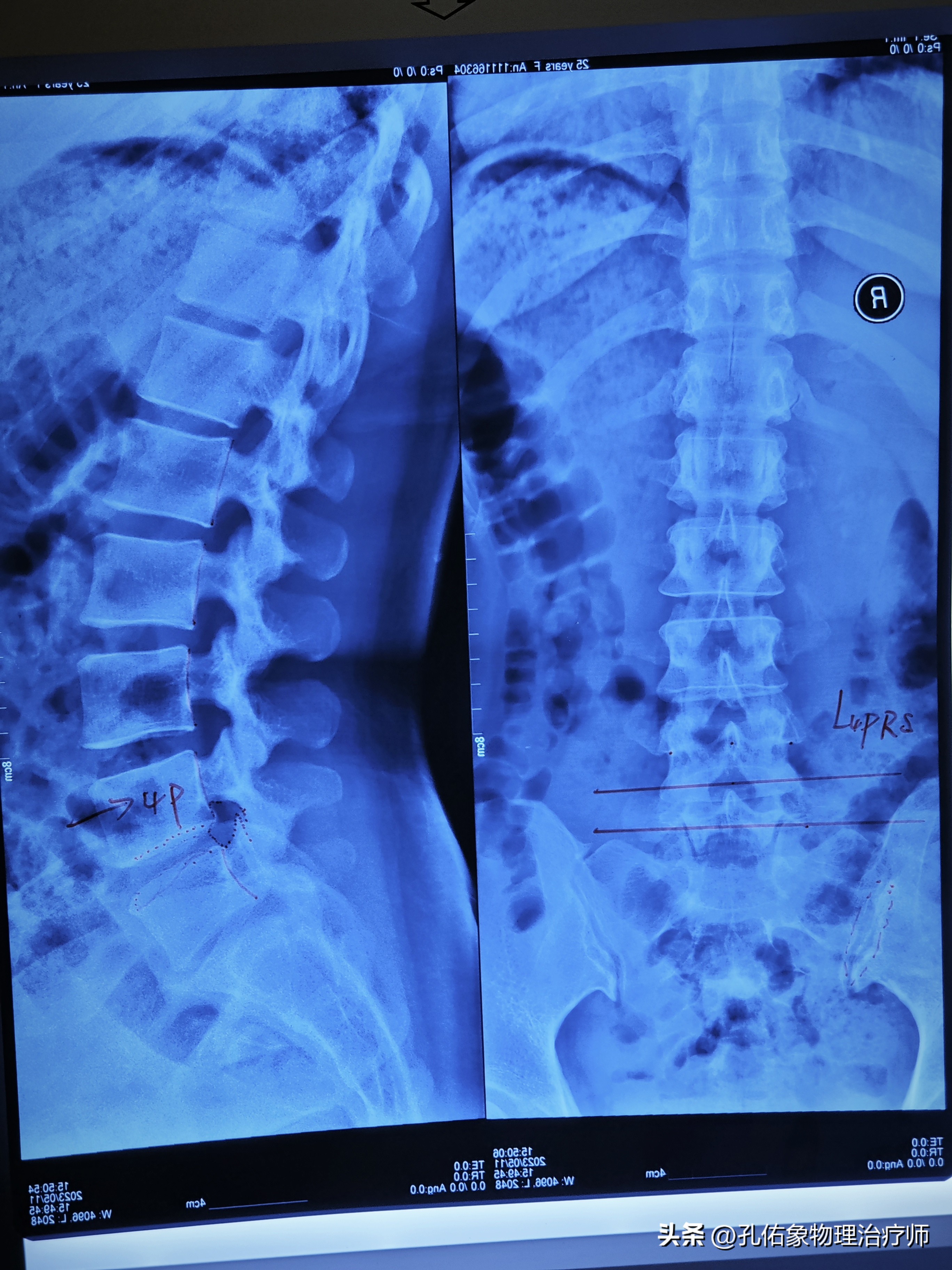从臀部到小腿麻木疼痛怎么回事,臀部小腿酸胀是怎么回事