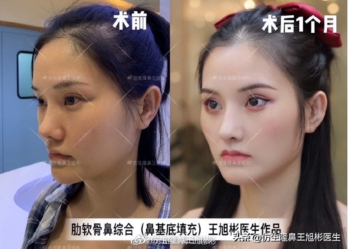 隆鼻鼻型科普,鼻基底凹陷隆鼻可以改善吗