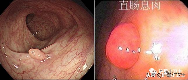 便血别担心不一定是直肠癌,便血不一定是肠癌吗