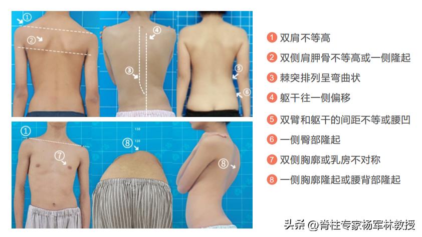 脊柱侧弯高低肩不明显,后背可以看出脊柱侧弯么