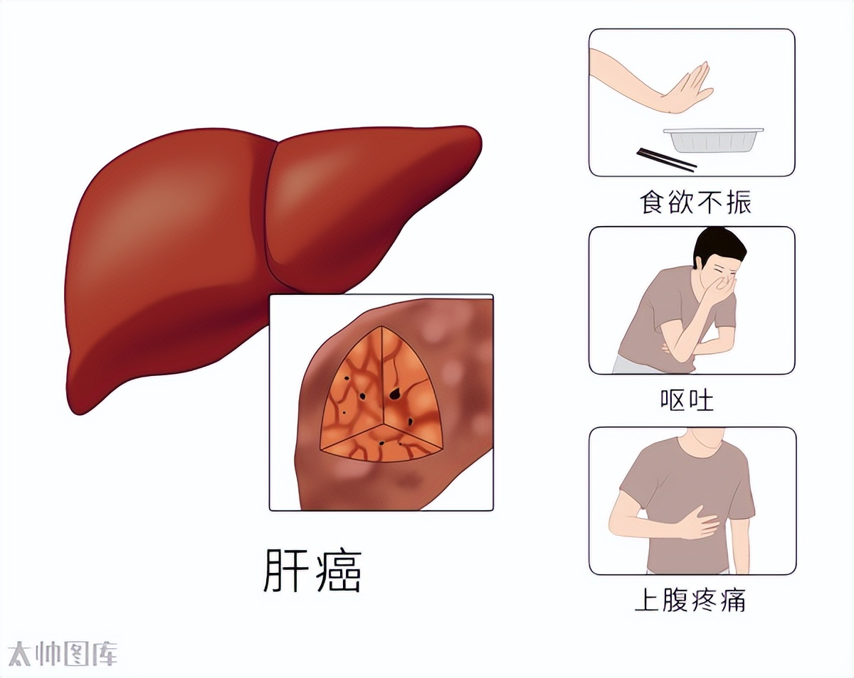 19种癌的早期信号和筛查建议——早知道能救命！