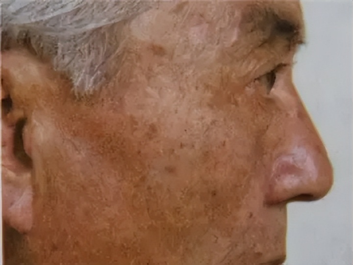 老年斑和色素沉着怎么区分,老年斑和色素沉着怎么治