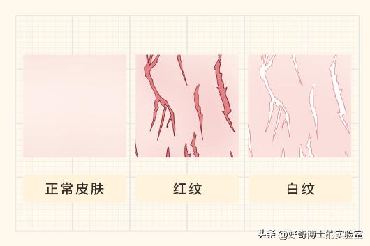 女生大腿外侧出现小条纹,为什么女生大腿上会有条纹