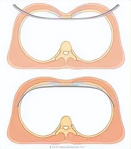 宝宝胸部凹陷怎么恢复,胸壁凹陷在身体哪个位置