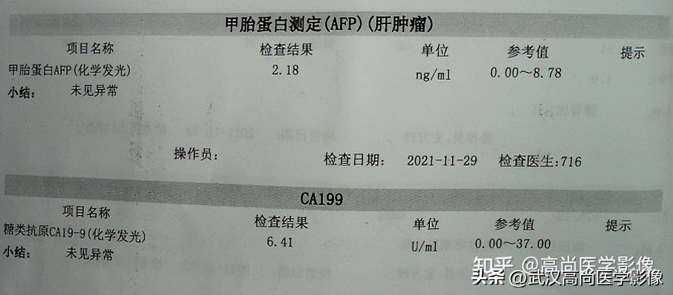 罕见卵巢恶性肿瘤,肿瘤罕见病