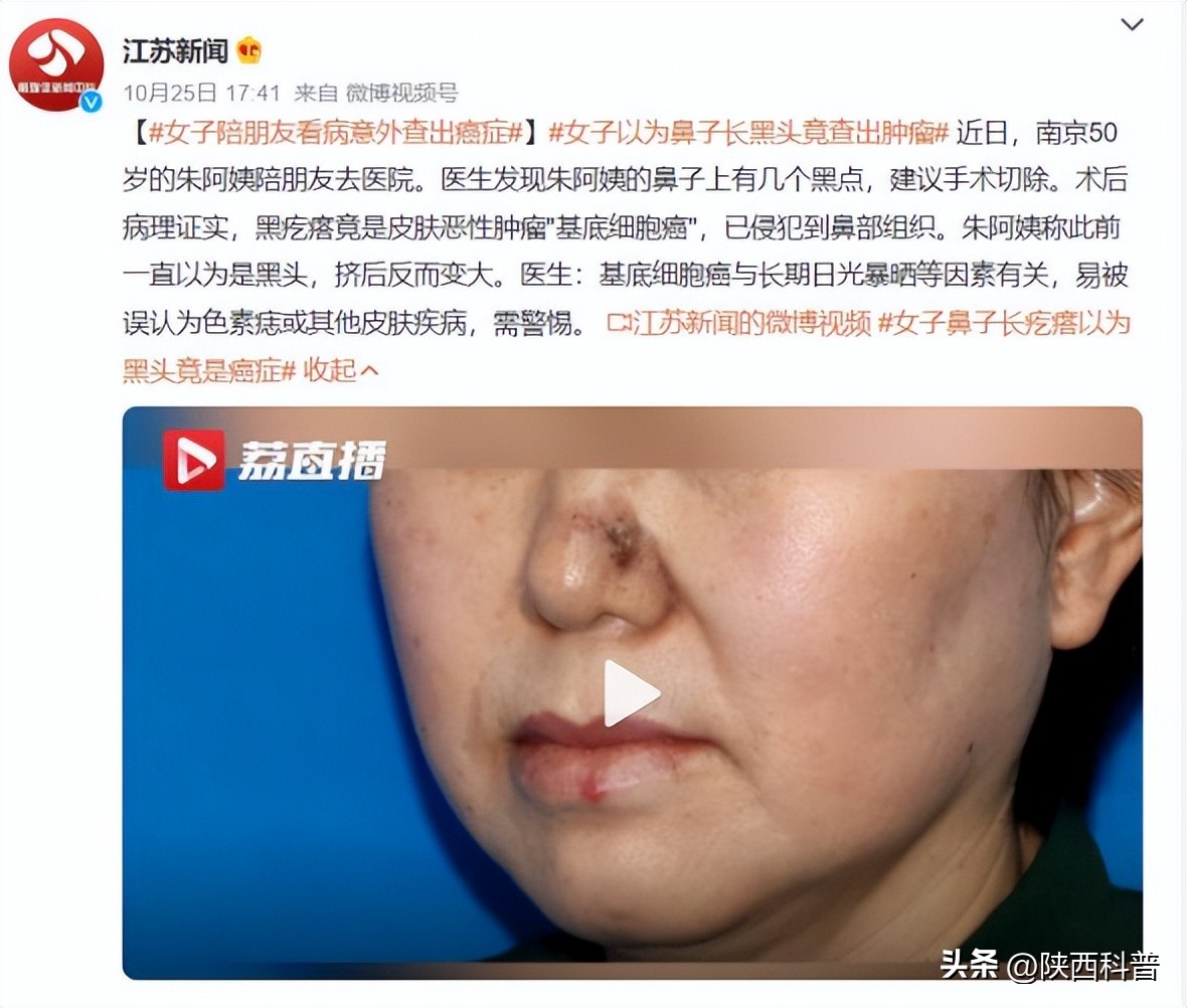 鼻子上的黑头的正确处理方法,鼻子上的黑头大家都是怎么解决的