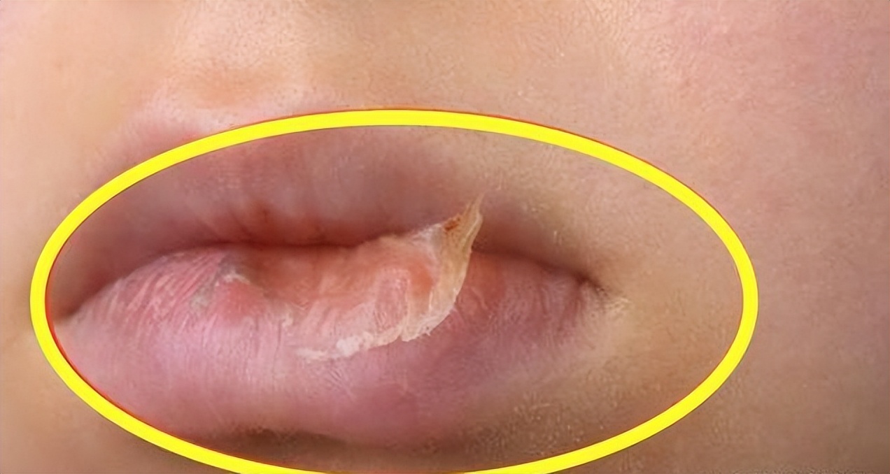 宝宝嘴裂了抹点什么,宝宝嘴巴裂了