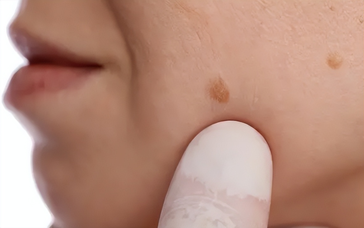身上长痣怎么查是不是癌症,身上长这种颜色的痣要当心癌症