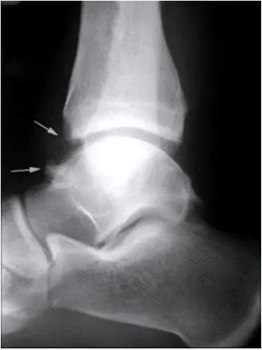 世界杯掀足球热，喜欢踢足球的人注意了，请小心“足球踝”