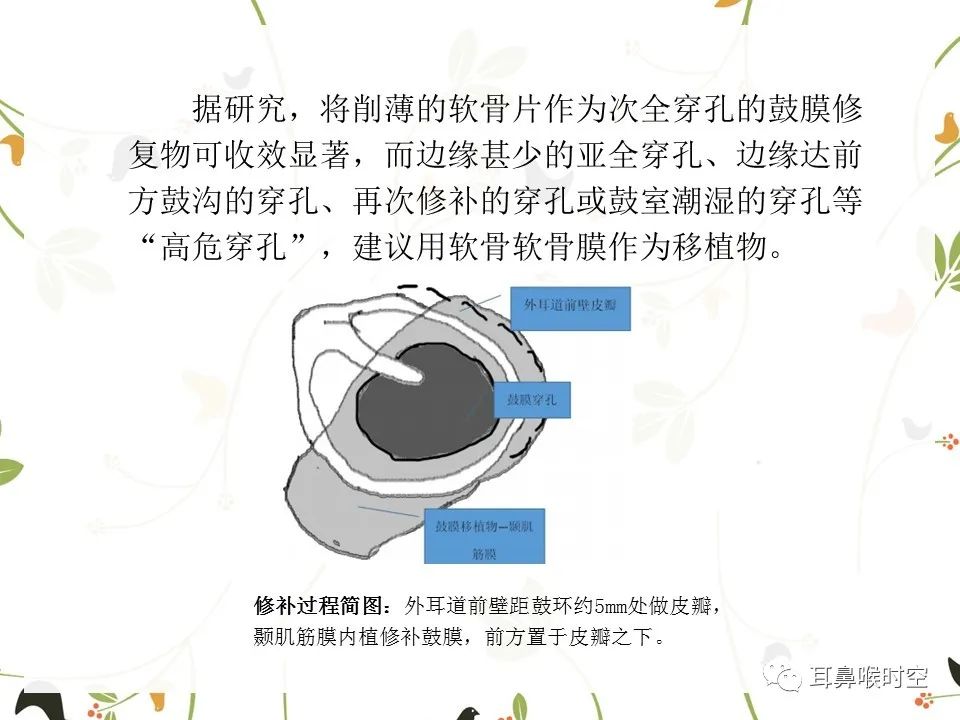 鼓膜可见穿孔,鼓膜穿孔听力下降能恢复吗