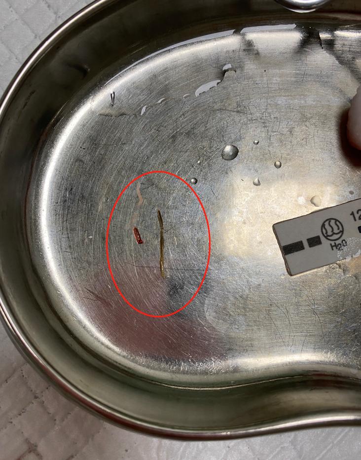 小孩被树枝戳到眼睛出血了,树枝戳伤小孩眼睛