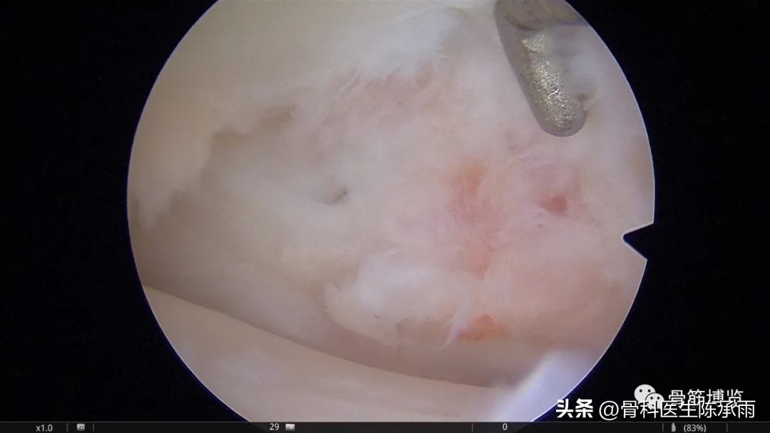 1-2度半月板后角损伤,半月板后角损伤手术解决方案