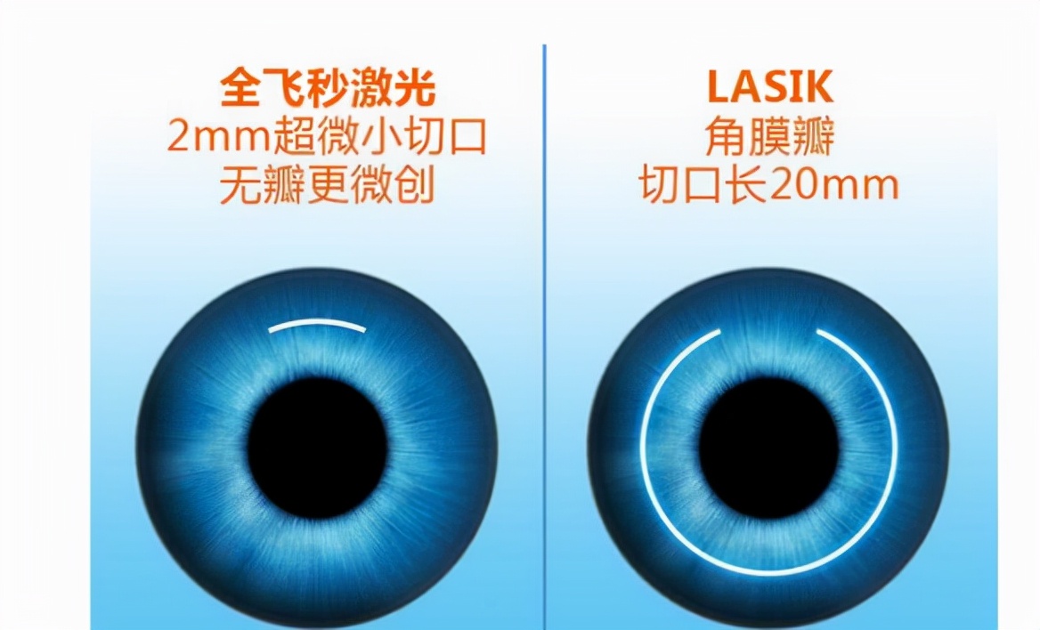 除了激光手术还有什么能矫正近视,近视植入晶体好还是激光矫正好