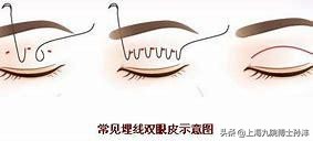 埋线双眼皮埋线痕迹明显怎么办,埋线双眼皮开线了会变成什么样子