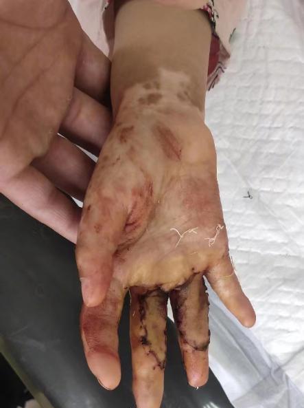 后妈虐待女童最新案件,后妈虐待13岁孩子新闻