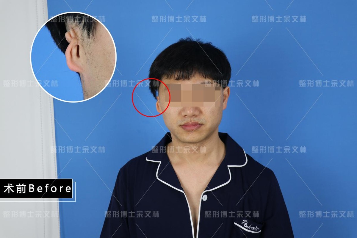 小耳畸形做耳再造哪位医生技术好,小耳畸形手术10年后效果图