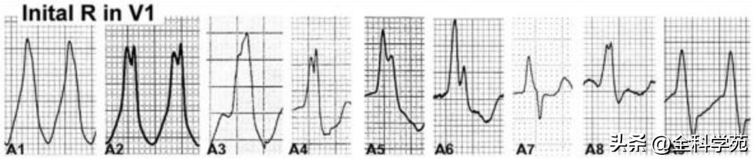 心电图上表现为宽qrs波,心电图中qrs是代表心动过速吗