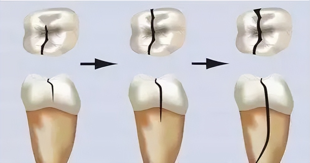 根管治疗牙齿劈裂还能保留吗,根管治疗后牙齿劈裂
