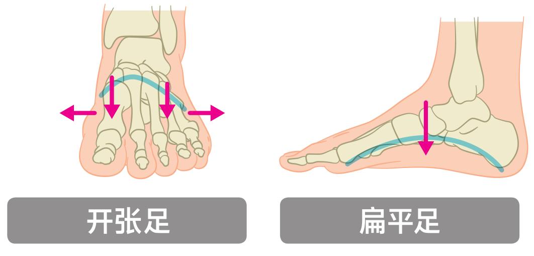 锻炼脚底跟腱的方法有哪些,足部跟腱拉伸的好处