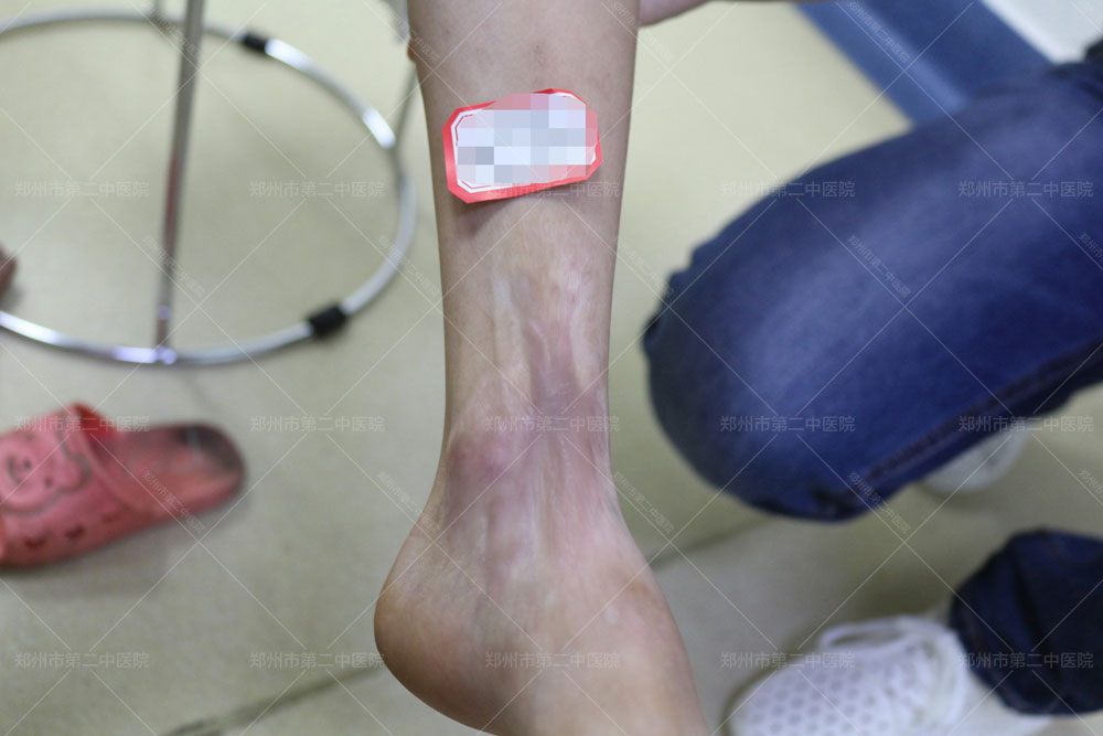郑州第二中医院疤痕,郑州烫伤疤痕哪里看