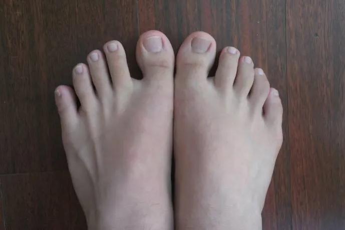 小脚趾被撞肿了怎么办,小脚趾被撞了骨头移位怎么办