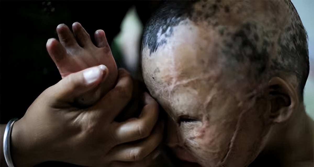 小孩被火烧伤戴面具,面具娃娃烧伤