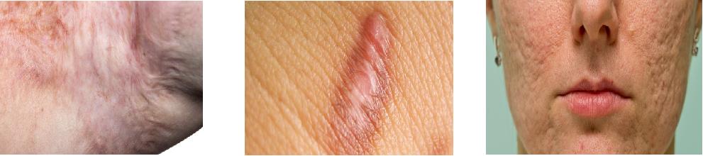 疤痕变黑发硬怎么办,疤痕红肿凸起怎么去除