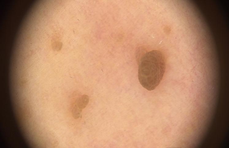 脖子上长个小肉揪怎么弄掉,脖子上长了一个小肉粒被揪下来