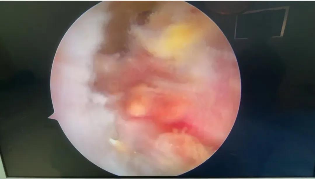 盆骨骨折手术,我的骨折后生活