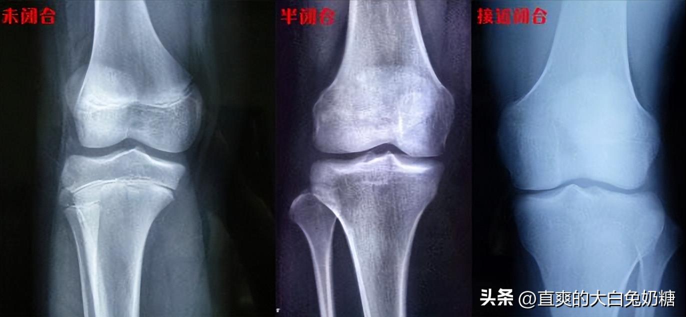 李亚诺断骨增高怎样了,断骨增高手术的李亚诺现状